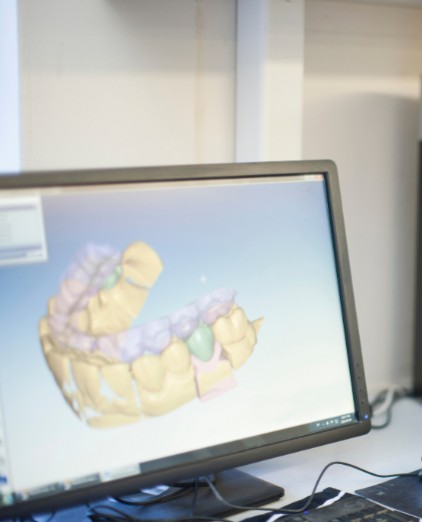 Digital Dental Impressions, Calgary Dentist