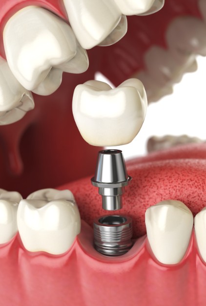 Dental Implants in Calgary